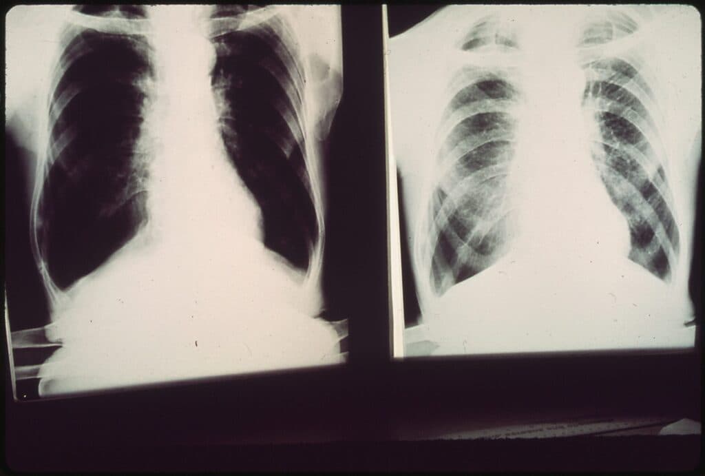KY’s Beshear backs black lung bill in Congress